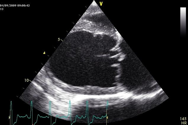 Echocardiographical appearance of valvular heart disease showing thickened, deformed and prolapsing valve leaflets and gross dilatation of the left ventricle and atrium